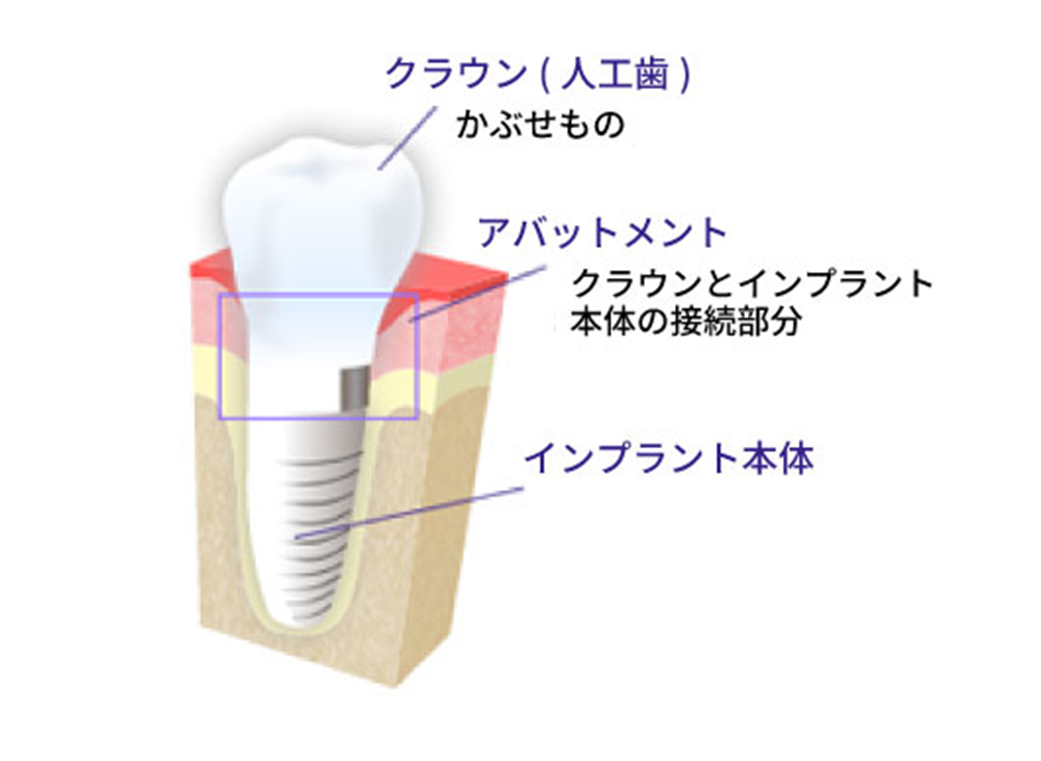 「第２の永久歯」と呼ばれる、天然歯に近い義歯です