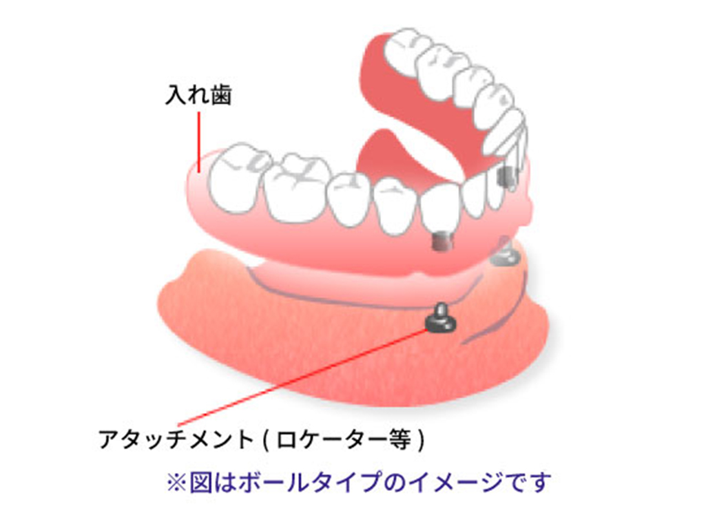 インプラントと入れ歯の利点を合わせた方法です