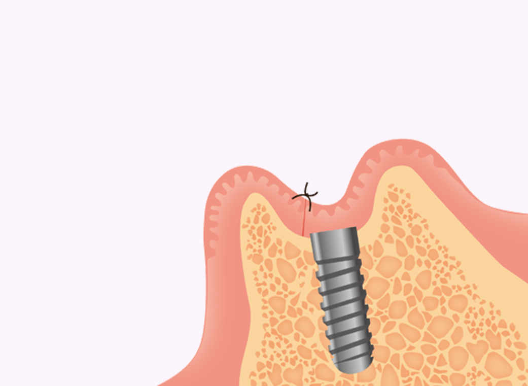 インプラントの埋入手術