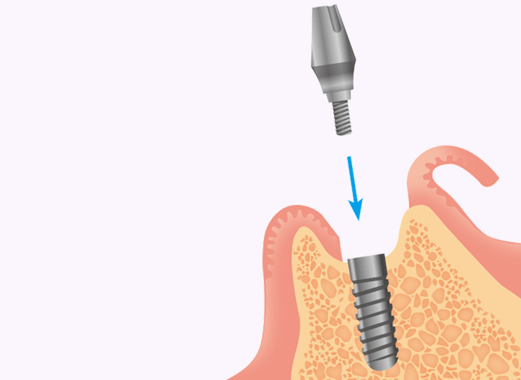 骨の癒着後、土台となるアバットメントを装着する