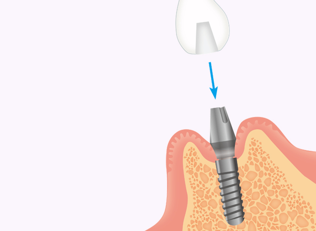 人工歯（クラウン）の製作と装着