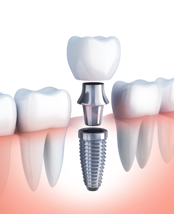 インプラント・入れ歯の豊富な経験